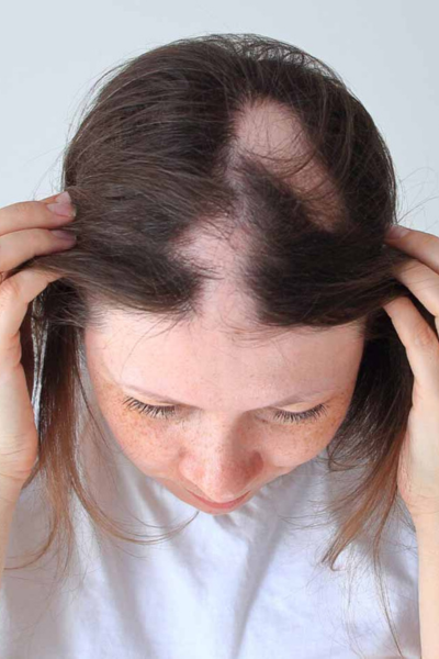 Hair Fall