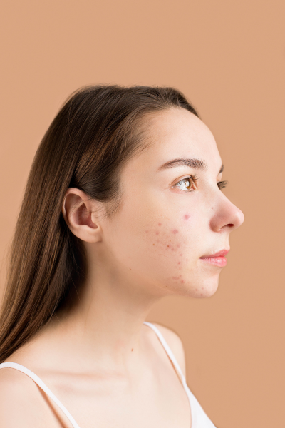 Acne & Pimple